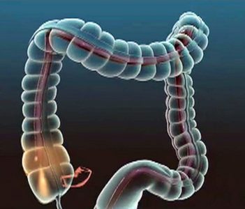 colonoscopy webmd